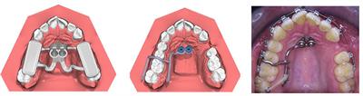 Accuracy of Sterile and Non-Sterile CAD/CAM Insertion Guides for Orthodontic Mini-Implants